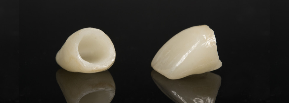 Dental Crowns