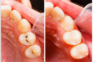 before and after teeth